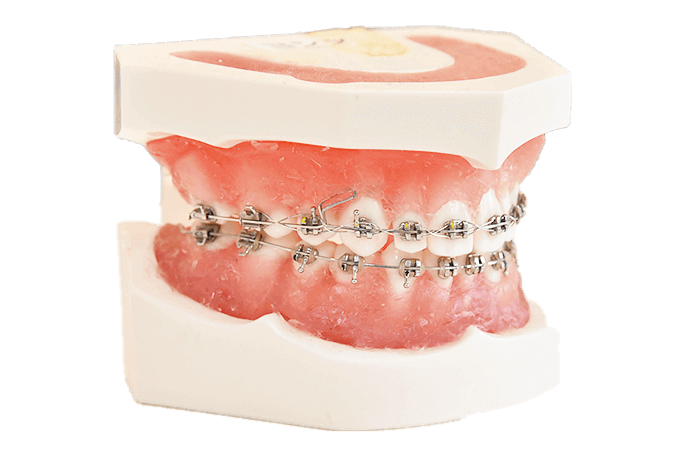 メタルブラケット矯正模型